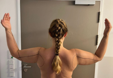 Nach der Lipödem-Liposuktion an den neuen Körper gewöhnen