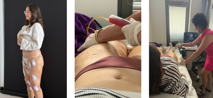 Lymphdrainage zur Linderung der Beweglichkeits-Beschwerden nach der OP