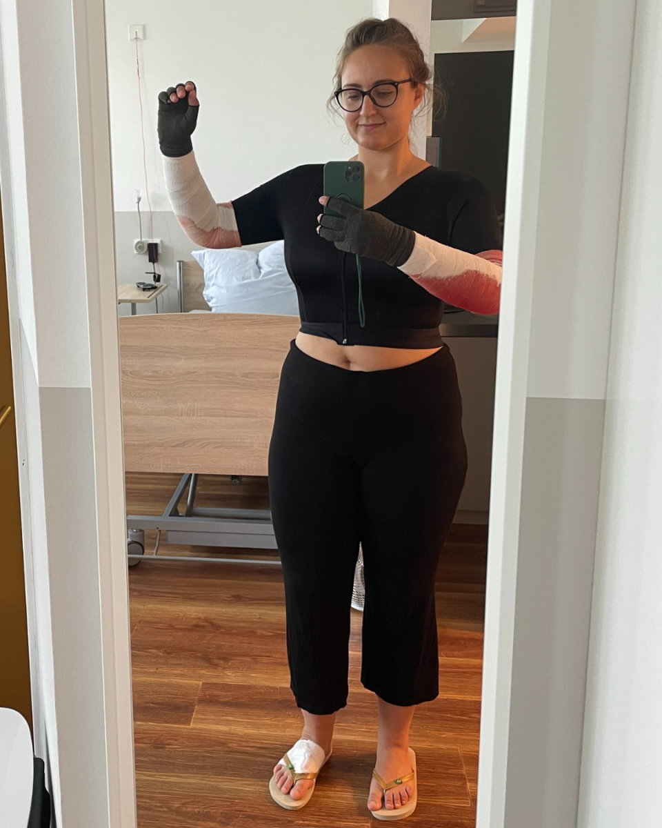 Lipödem Heldin Juliane nach ihrer Arm-Liposuktion