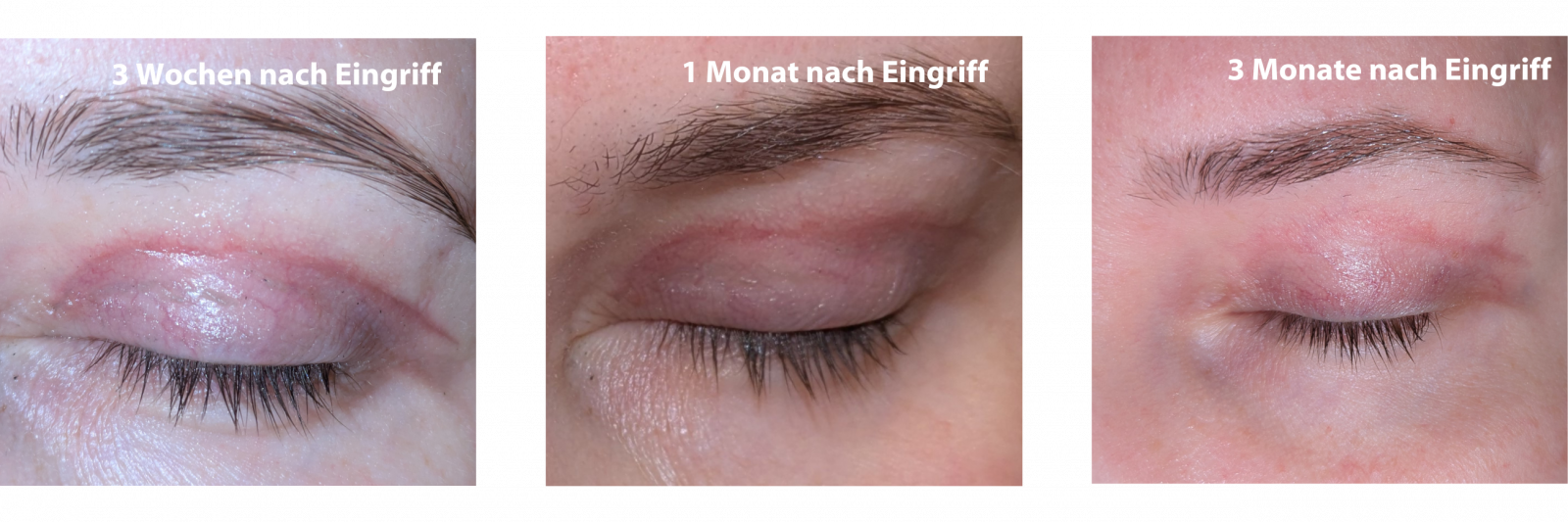 Heilungsverlauf der Narbe nach einer Augenlidstraffung in den ersten 3 Monaten danach.
